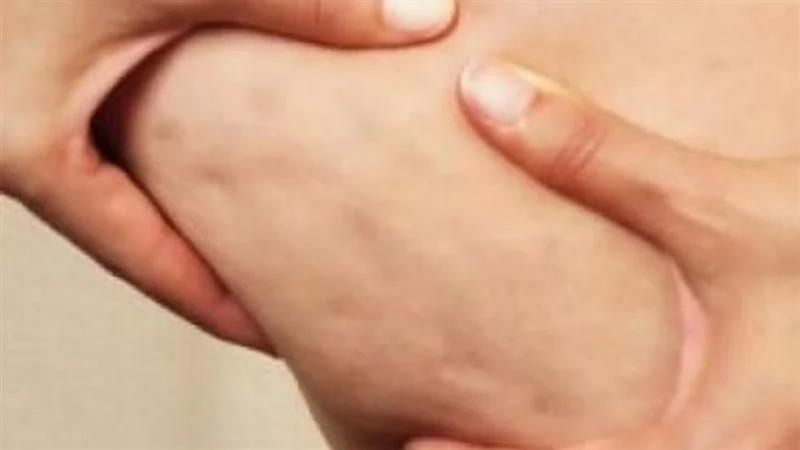 وصفات طبيعية لإزالة السلوليت من الجسم