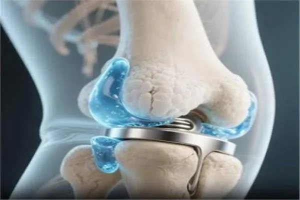  دراسة تفتح بابا للقلق: جزيئات من المفاصل الصناعية تصل للدماغ وهذه حقيقة تأثيرها 